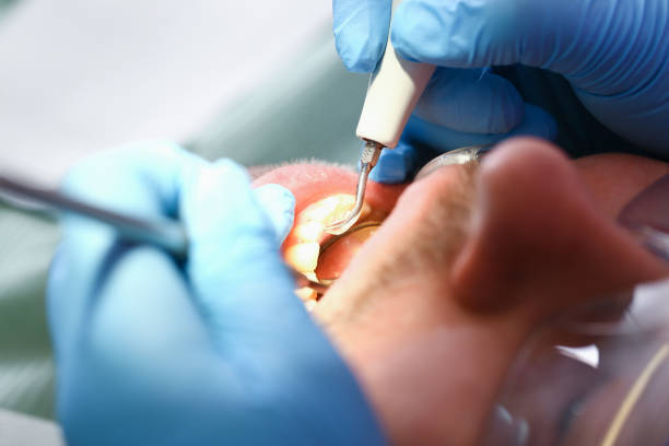 Best Emergency Gum Treatment in North Sarasota, FL